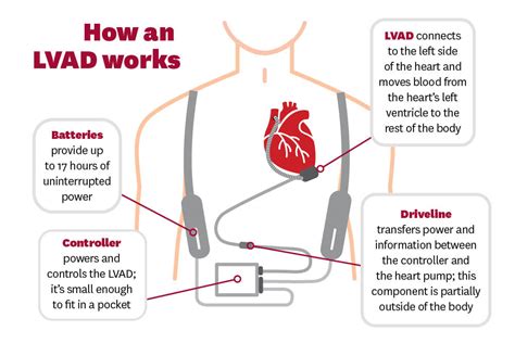 LVAD Sustains Mother Awaiting New Heart - Keck Medicine of USC