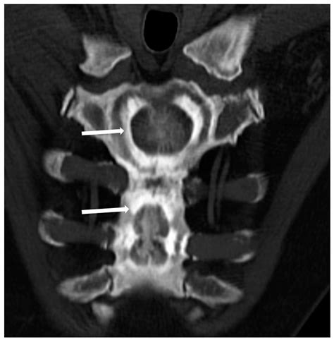 Skeletal Imaging Features In Osteopetrosis Encyclopedia MDPI