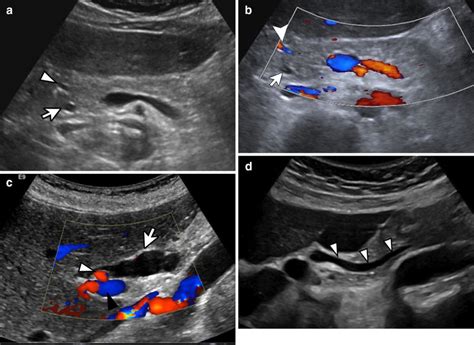 Imaging Of Common Bile Duct By Linear Endoscopic Ultrasound 41 Off