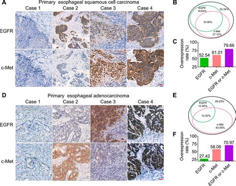 Complementary Expression Of Egfr And C Met In Primary Escc And Eac