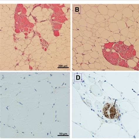 Results Of Muscle Biopsy Of Left Quadriceps A H E Stain Showing