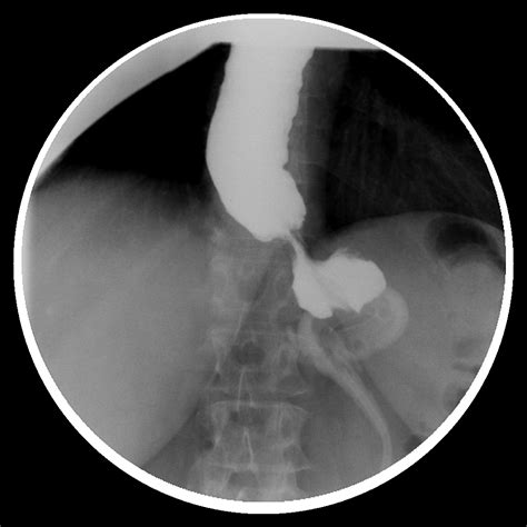 Tight Gastric Band Causing Esophageal Dilatation And Dysmotility