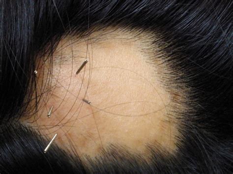 Treatment For Hair Loss Philadelphia Acupuncture Clinic Dr Tsan