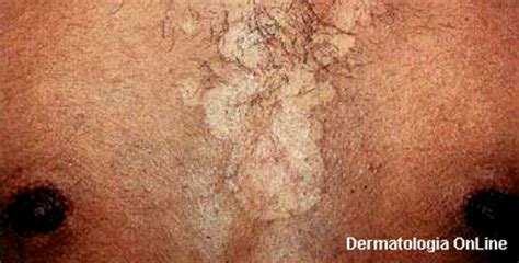 Dermatite Seborreica Caspa Seborr Ia Imagens Dermatologia