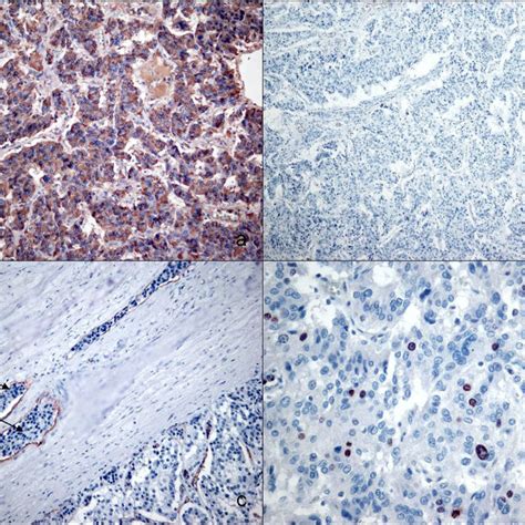 A Diffuse Granular Cytoplasmic Staining For Chromogranin A B