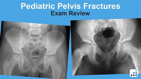 Pediatric Pelvic Fractures Exam Review Lindsay Andras Md Youtube