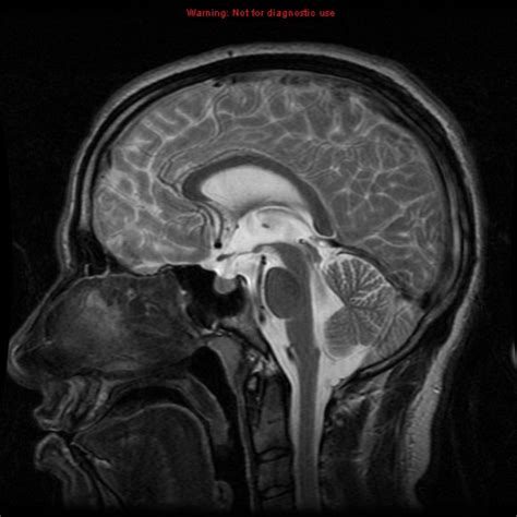 Dermoid Cyst Image