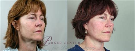 Facelift Before And After Pictures Case 6 Paramus Nj Parker Center For Plastic Surgery