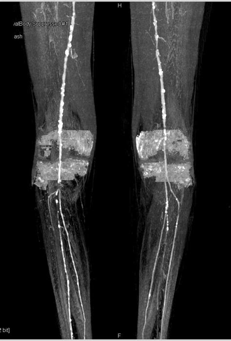 Cta Runoff With Pvd Peripheral Vascular Disease Vascular Case