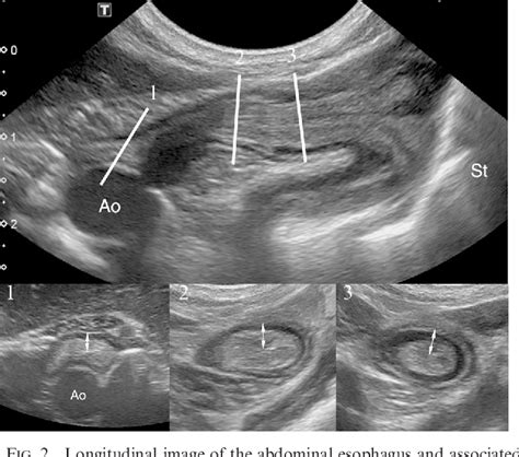 Gastroesophageal Junction Ultrasound