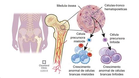 Leucemias o que são origem e tipos de cânceres do sangue Sanar Medicina