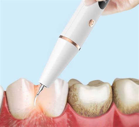 D Tartreur Dentaire Lectrique Instantan Retrait Du Tartre Dentaire
