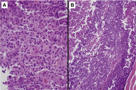 Histopathology study for cervical cancer. | Download Scientific Diagram