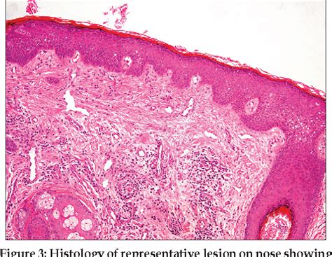 Papular Acne Scars of the Nose and Chin: An Under-recognised Variant of Acne Scarring | Semantic ...