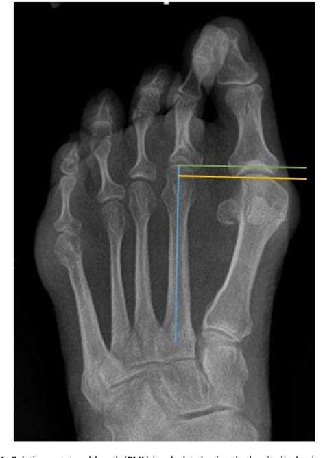 Figure 1 from First Tarsometatarsal Joint Fusion for Hallux Valgus ...