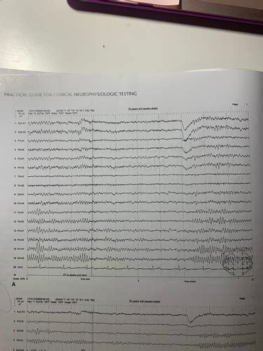 6 Principles Of Visual Analysis Of EEG Flashcards Quizlet