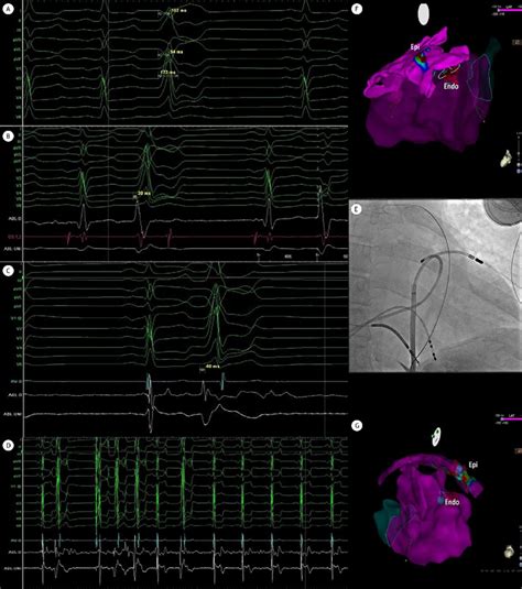 The Images Depict The Successful Ablation Of An Lvs Pvc Via The