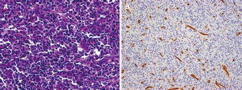 Different Imaging Findings Of Inflammatory Myofibroblastic Tumor Of The