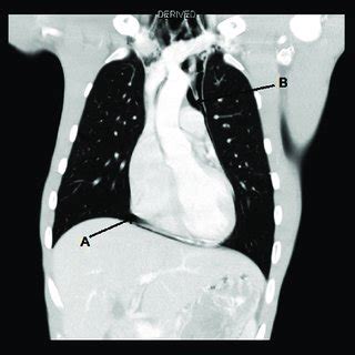 Coronal view on CT scan showing pneumomediastinum around the heart A ...