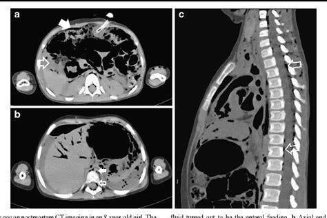 Figure From Minisymposium Post Mortem Imaging Normal Pediatric