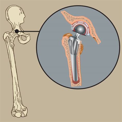 Hip Replacement Illustrations Royalty Free Vector Graphics And Clip Art