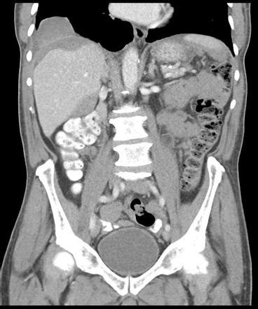 Malignant peritoneal mesothelioma | Radiology Reference Article ...