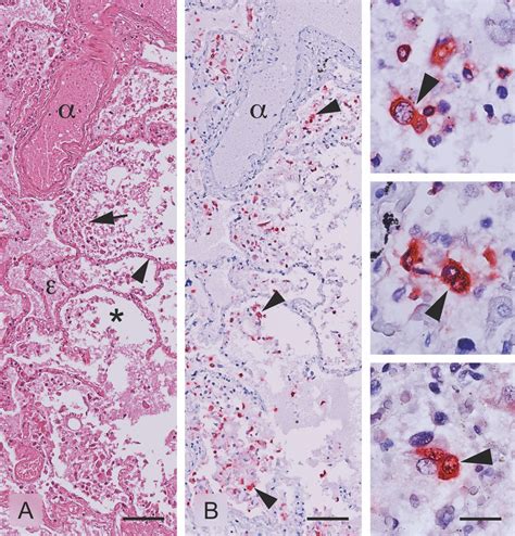 Detection Of Sars Cov Antigens In Lung Tissue Of A Fatal Case With