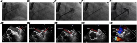 Frontiers Percutaneous Left Atrial Appendage Closure Using The Lambre