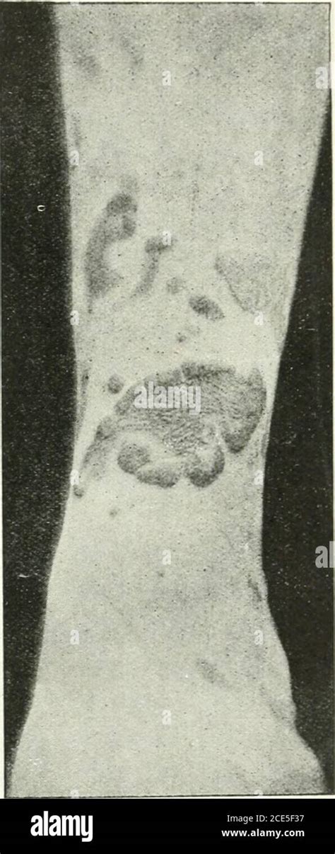 Xanthoma Hi Res Stock Photography And Images Alamy