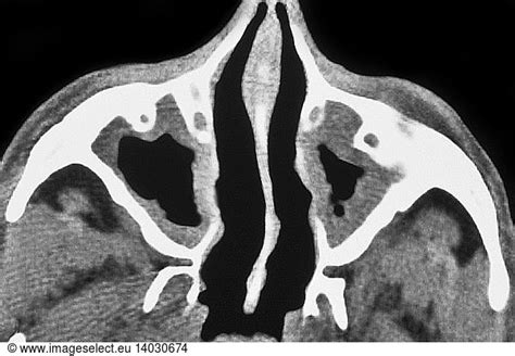 Maxillary Sinusitis Maxillary Sinusitis Ct Scan Abnormal Abnormality