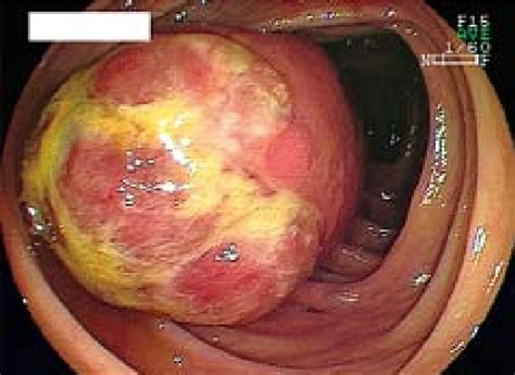 Figure 2 From Ileal Schwannoma Developing Into Ileocolic