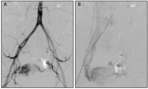 Endovascular Today Diagnosis And Treatment Of Uterine And Pelvic Arteriovenous Malformations