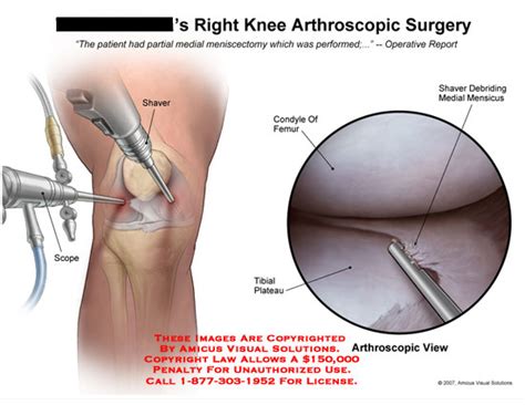 Right Knee Arthroscopic Surgery