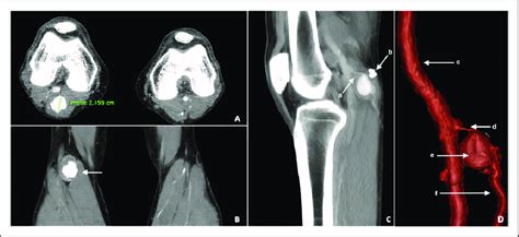 Preoperative Computed Tomography Angiography A And B Axial And