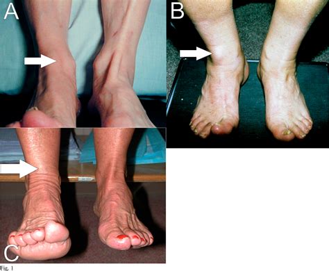 Tibialis Anterior Tendon Tear