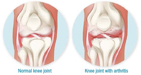 Moving Away From Knee Osteoarthritis Chiropractor Melbourne Cityhealth