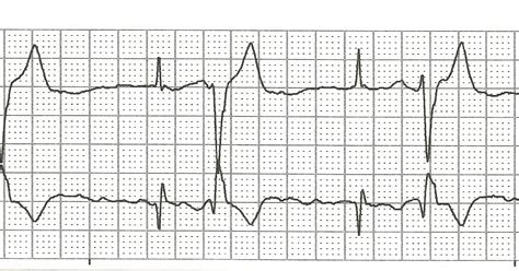 EKG Rhythm Strips 81: Bigeminy, Trigeminy, Quadrigeminy...