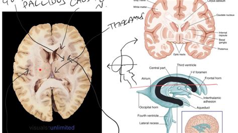 Interpreting A Transverse Section Through Brain Youtube