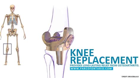 Total Knee Replacement Anatomy