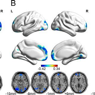 Results Of Voxel Based Morphometry VBM Analyses Colder Or Warmer