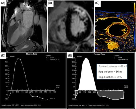 Aortic Regurgitation A Multimodality Approach Siani 2022 Journal