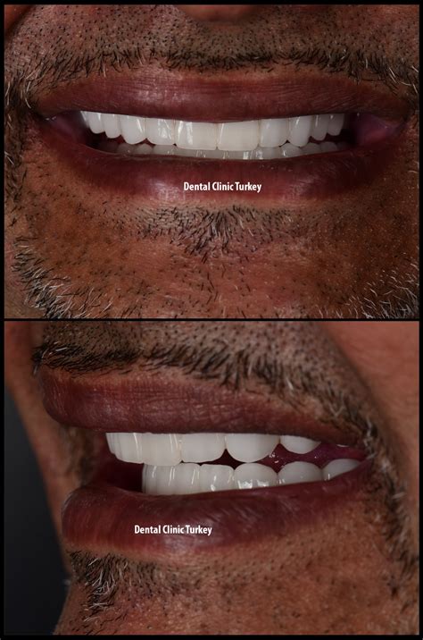 Vorher Nachher Zahnarzt T Rkei Implantat Zirkonkrone Veneers