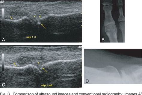 Figure 5 from Diagnosis of gout by ultrasound. | Semantic Scholar