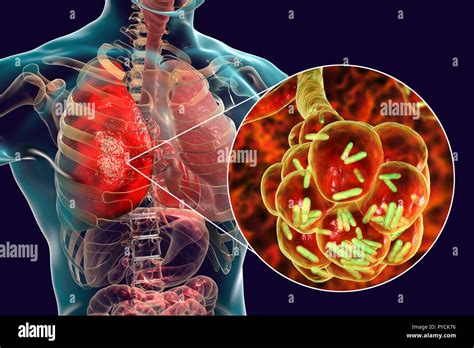 Bacterial Lung Infections Types