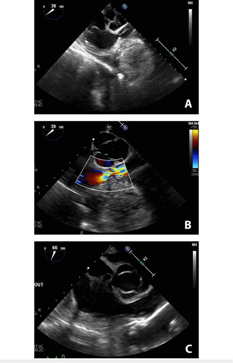 Transesophageal Echocardiography Imaging A Transesophageal Download Scientific Diagram