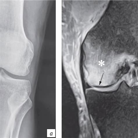 Knee radiograph (а) and magnetic resonance image (MRI) scan (b)... | Download Scientific Diagram