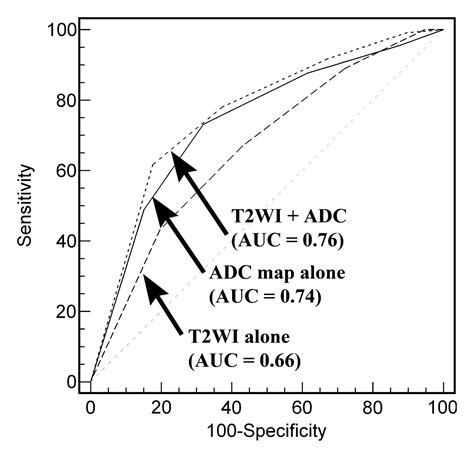 Prostate Cancer Apparent Diffusion Coefficient Map With T2 Weighted