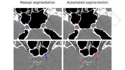 Radiology Artificial Intelligence On Twitter Segmentation And Volume