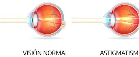 Qu Es El Astigmatismo Rea Oftalmol Gica Avanzada