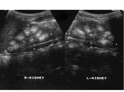 Bilateral Medullary Nephrocalcinosis In A Baby With Idiopathic